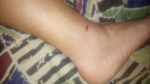 HEMA injury, ankle wound, HEMA mistake